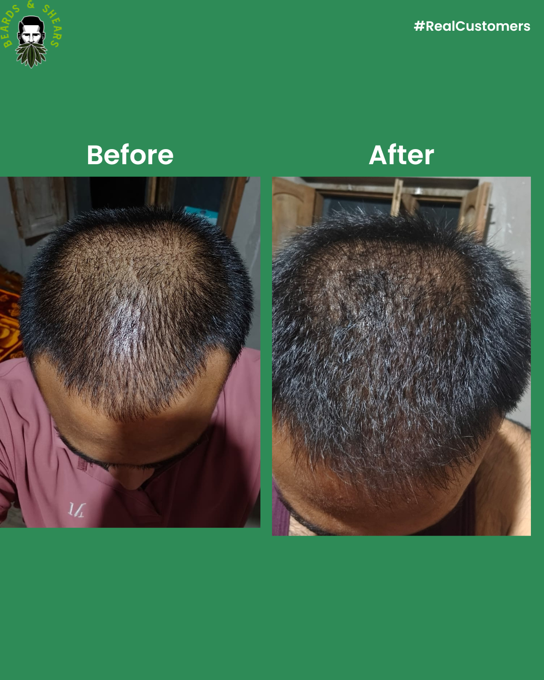 Minoxidil + Hemp Hair Serum | Boosting Hair Growth And Controls Hair Fall - 30ml