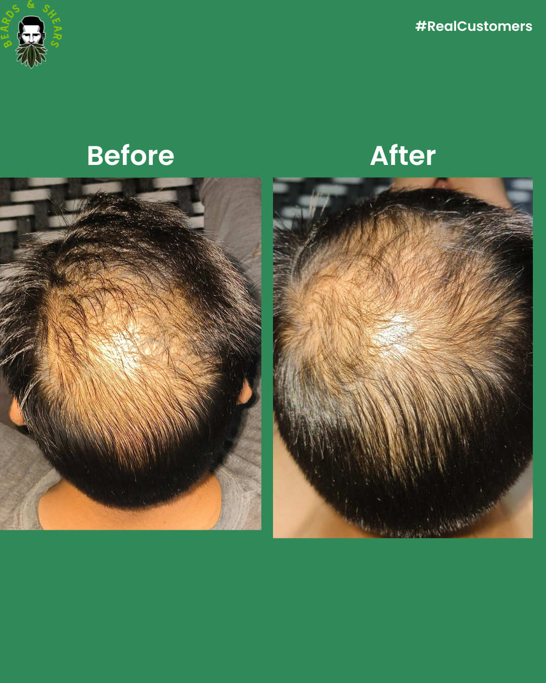 Minoxidil + Hemp Hair Serum | Boosting Hair Growth And Controls Hair Fall - 30ml