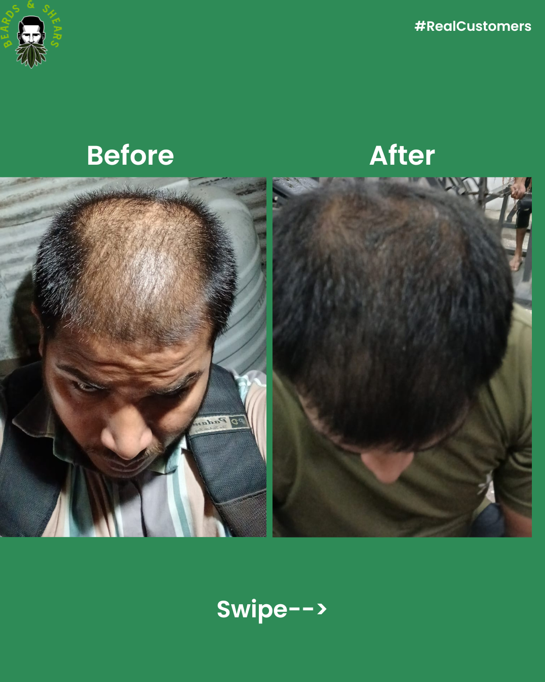 Buy 1 Get 1 Free - Minoxidil + Hemp Hair Growth Serum | Boosting Hair Growth And Controls Hair Fall - 30ml + 30ml FREE