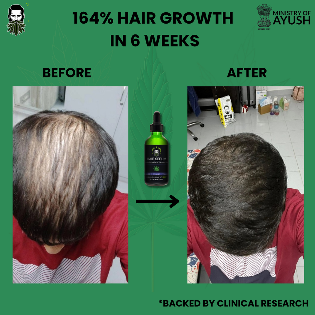 Buy 1 Get 1 Free - Minoxidil + Hemp Hair Growth Serum | Boosting Hair Growth And Controls Hair Fall - 30ml + 30ml FREE