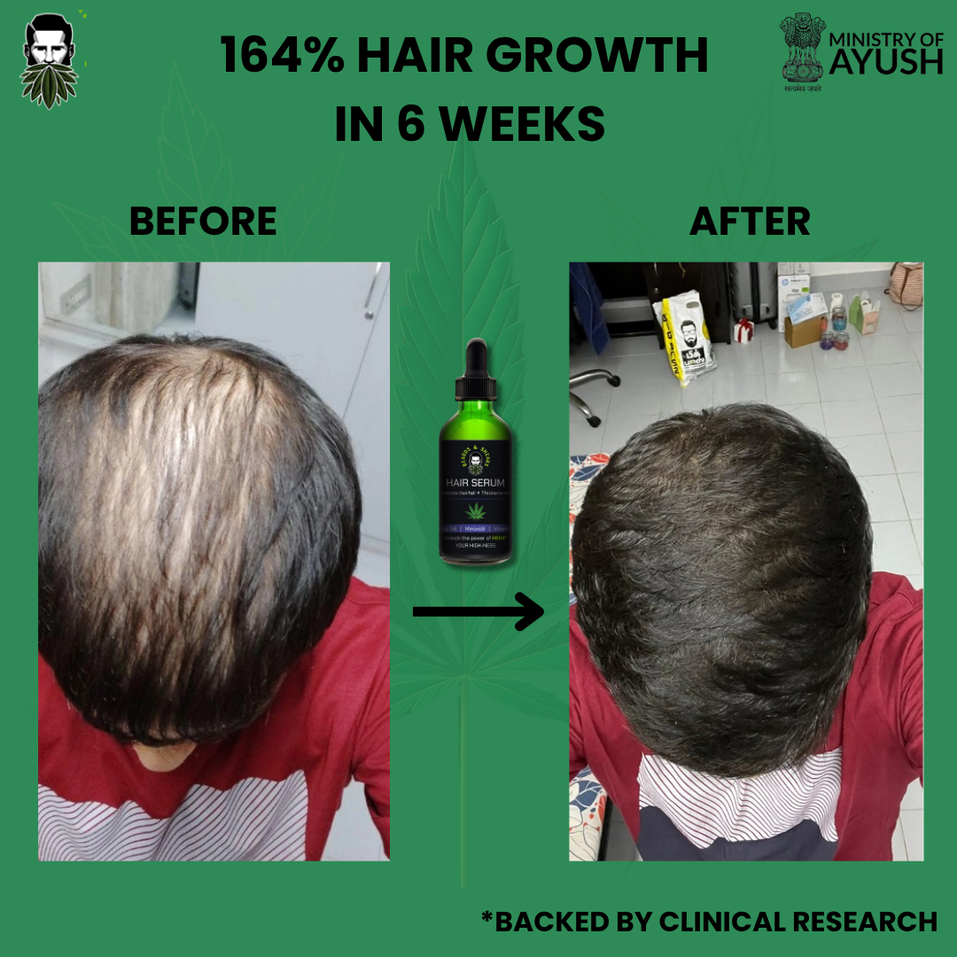 Buy 1 Get 1 Free - Minoxidil + Hemp Hair Growth Serum | Boosting Hair Growth And Controls Hair Fall - 30ml + 30ml FREE