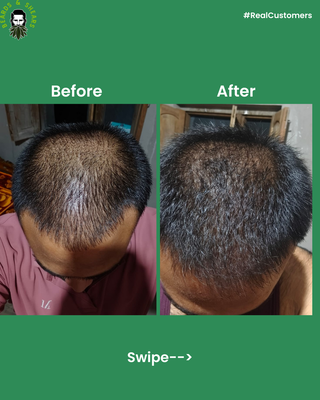 Buy 1 Get 1 Free - Minoxidil + Hemp Hair Growth Serum | Boosting Hair Growth And Controls Hair Fall - 30ml + 30ml FREE