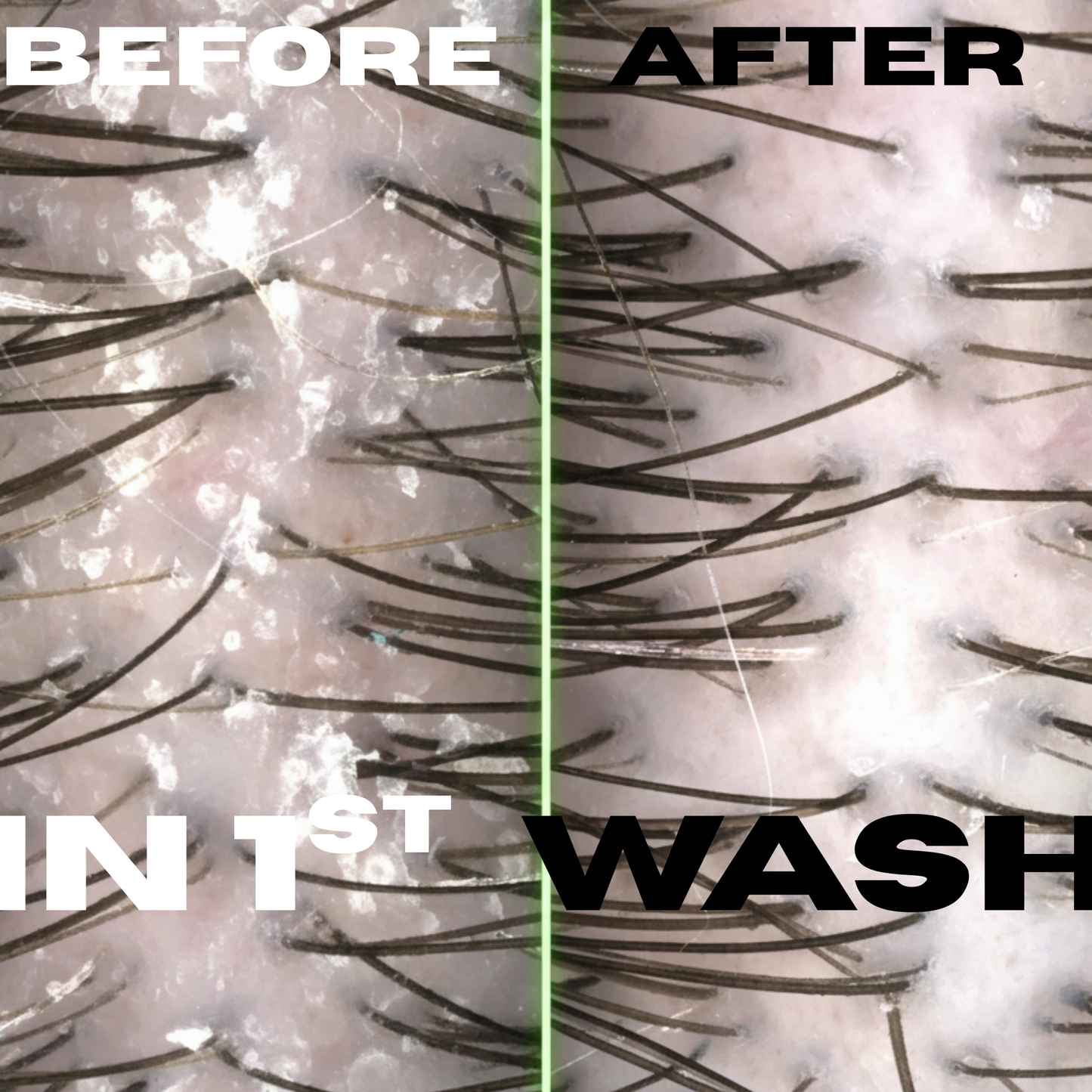 The Fu*k OFF Dandruff Combo - Eliminates Dandruff & Regrows Hair in 6 weeks