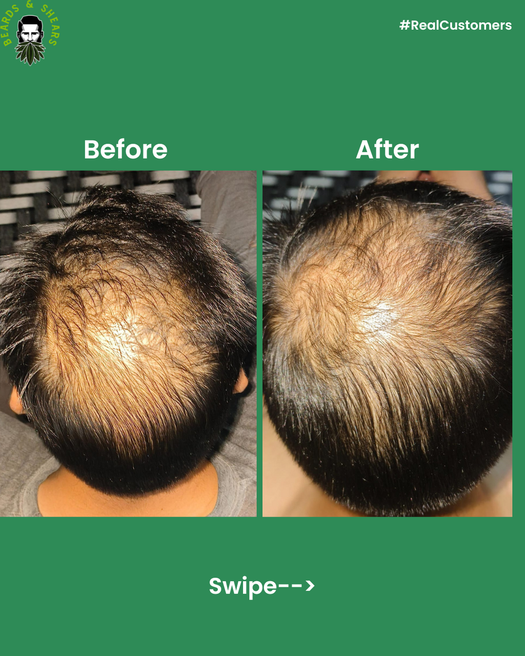 Buy 1 Get 1 Free - Minoxidil + Hemp Hair Growth Serum | Boosting Hair Growth And Controls Hair Fall - 30ml + 30ml FREE