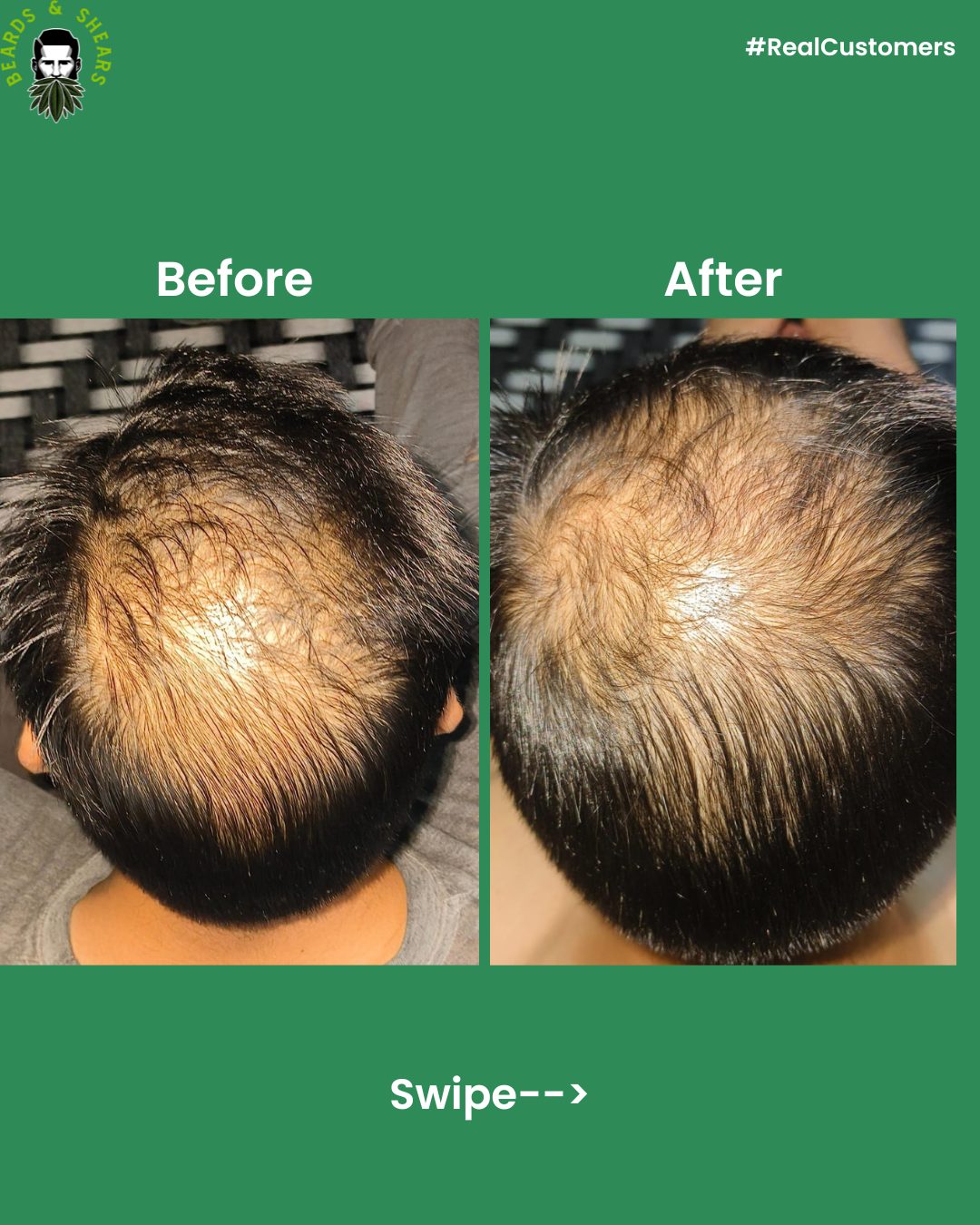 Buy 1 Get 1 Free - Minoxidil + Hemp Hair Growth Serum | Boosting Hair Growth And Controls Hair Fall - 30ml + 30ml FREE
