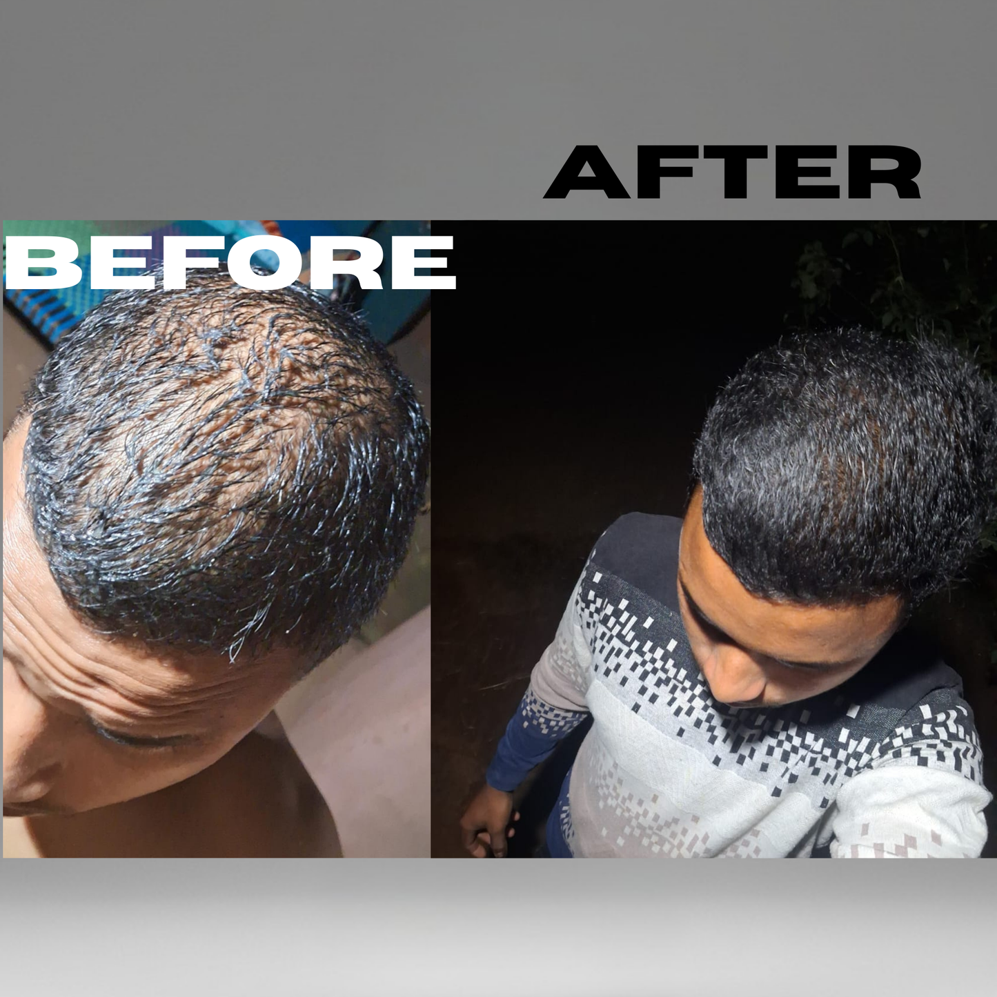 The Fu*k OFF Dandruff Combo - Eliminates Dandruff & Regrows Hair in 6 weeks