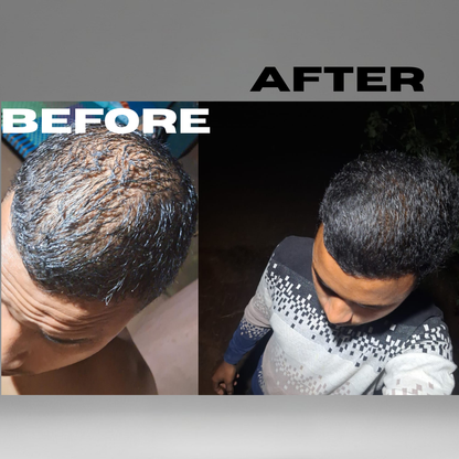 The Fu*k OFF Dandruff Combo - Eliminates Dandruff & Regrows Hair in 6 weeks