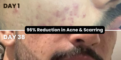 The Ultimate Face Combo - Fights Acne, Tan & Pollution