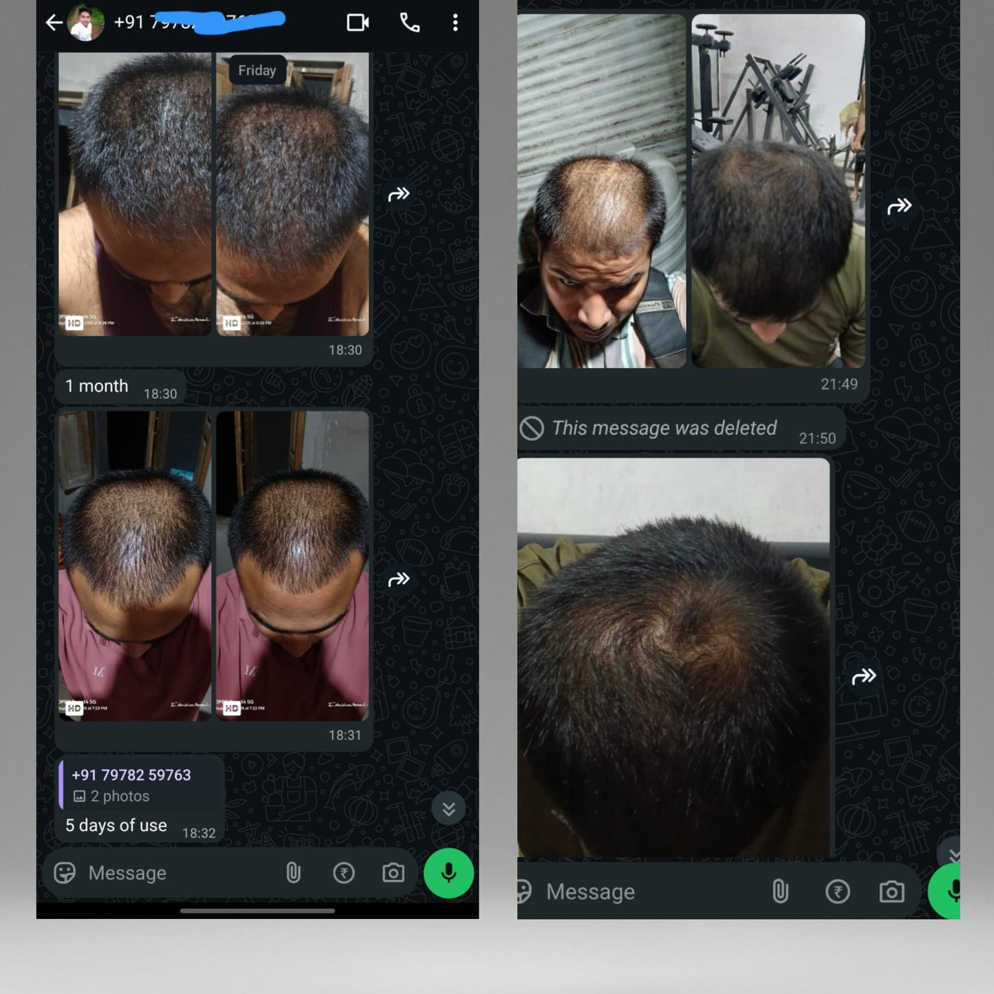 The Fu*k OFF Dandruff Combo - Eliminates Dandruff & Regrows Hair in 6 weeks