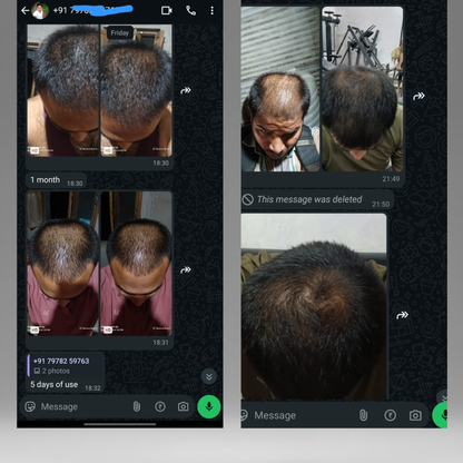 The Fu*k OFF Dandruff Combo - Eliminates Dandruff & Regrows Hair in 6 weeks