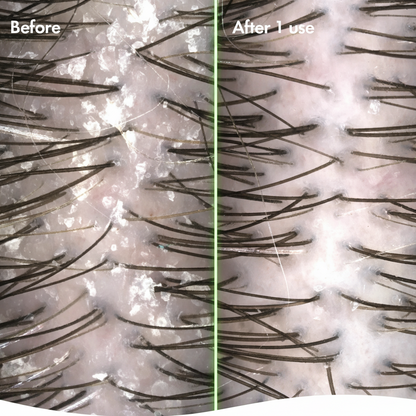 Anti Dandruff Shampoo 250ml | Contains Piroctone Olamine, Activated Charcoal & Hemp Seed Oil