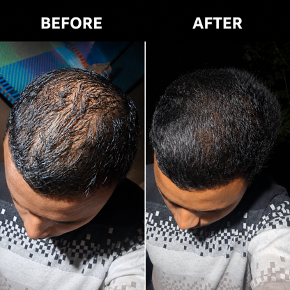 Anti Dandruff & Hair Growth Combo | Piroctone Olamine Shampoo + Minoxidil Hair Serum
